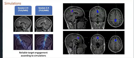 Workshop Day 1: Ultrasound Neuromodulation for Mental Health Applications video cover