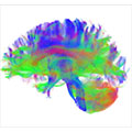 Diffusion image shows long distance connections in brain of study participant.