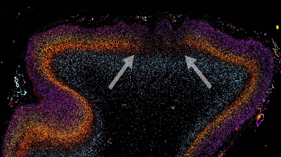 Disorganized cortical patch